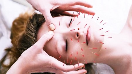 Иглоукалывание