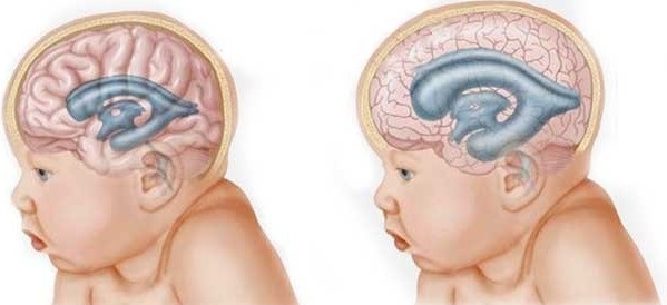 Гидроцефалия