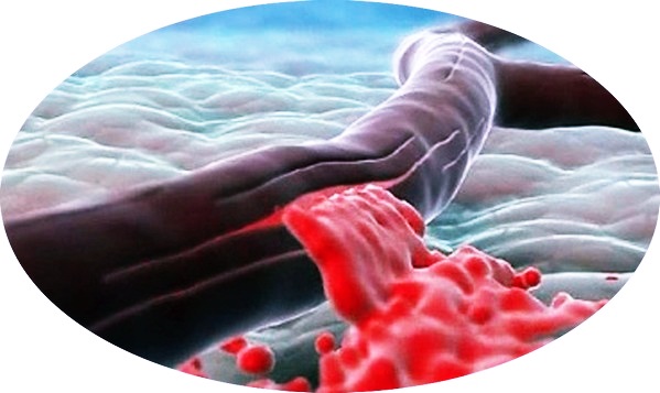 Повреждённый сосуд