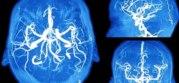 Аневризма головного мозга