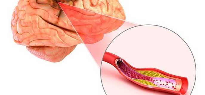 От чего появляется церебральный атеросклероз