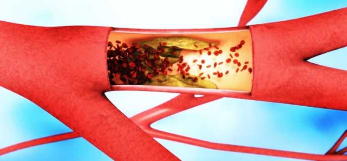 Причины образования бляшек в сосудах