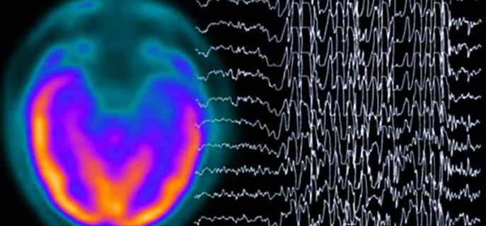 Умеренные диффузные изменения БЭА головного мозга: причины и симптомы, методы диагностики и лечения