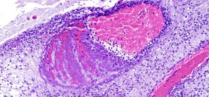 Последствия заболевания менингитом у детей