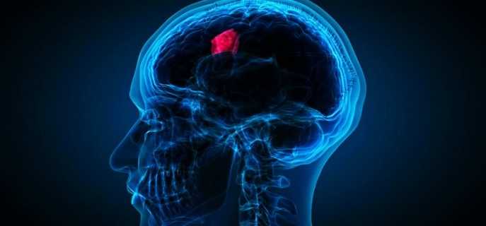 Жизнь после удаления опухоли головного мозга