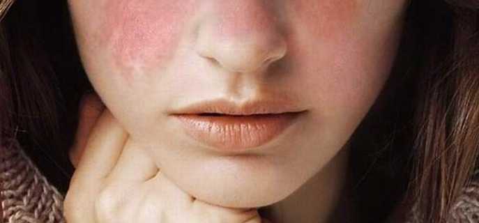 Продолжительность жизни при подозрении на системную волчанку