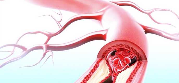 Лучшая диета при атеросклерозе сосудов головного мозга