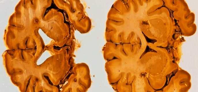 Причины атрофии головного мозга и их характеристики