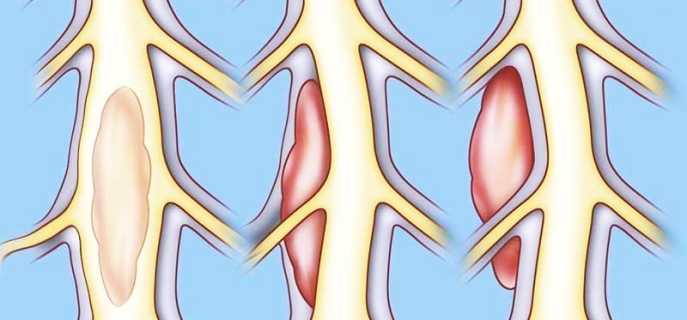 Виды, причины, признаки и способы лечения опухолей спинного мозга