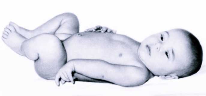 Причины, проявления и лечение паралича Дюшена-Эрба