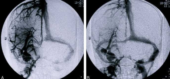 Виды ангиом головного мозга