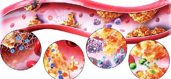 Лечение атеросклероза сосудов головного мозга