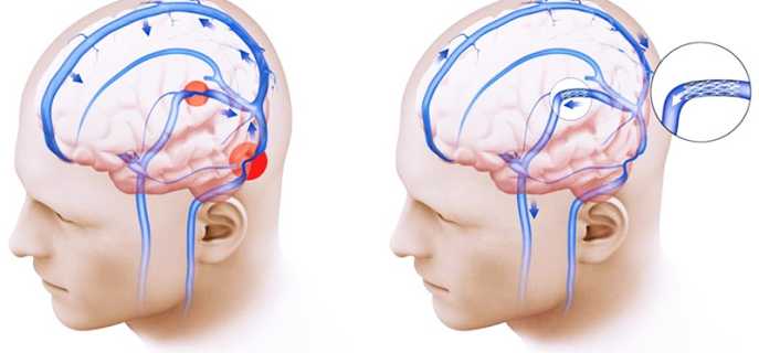 Причины и симптомы внутричерепной гипертензии