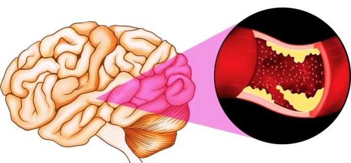 Церебральная ишемия у детей