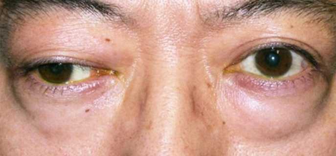 Методы лечения миастении