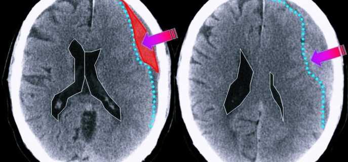 Разновидности и причины субдуральных гематом