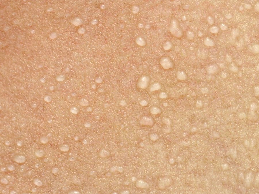 Кристаллическая потница на коже человека