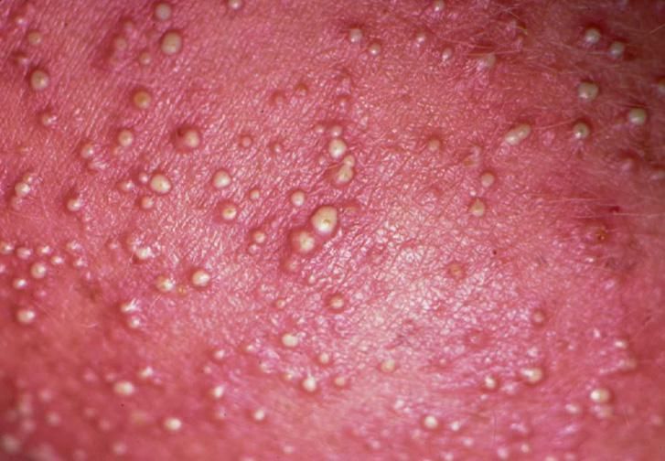 Папулезная потница, развивающаяся вследствие заражения инфекцией