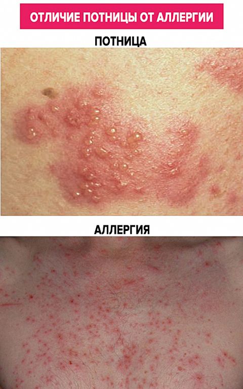 Отличие потницы от аллергии
