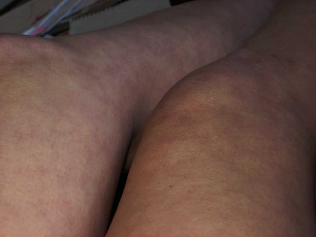 Каковы причины мраморной кожи у взрослых и детей. Симптомы, диагностика и лечение