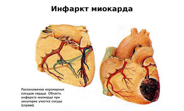Сердце с участком некроза вызванного инфарктом
