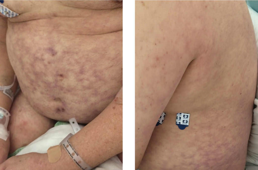 Каковы причины мраморной кожи у взрослых и детей. Симптомы, диагностика и лечение