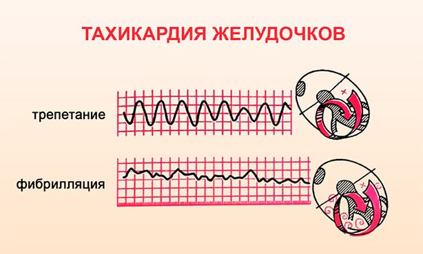 Желудочковая аритмия