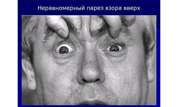 Парез взора вверх