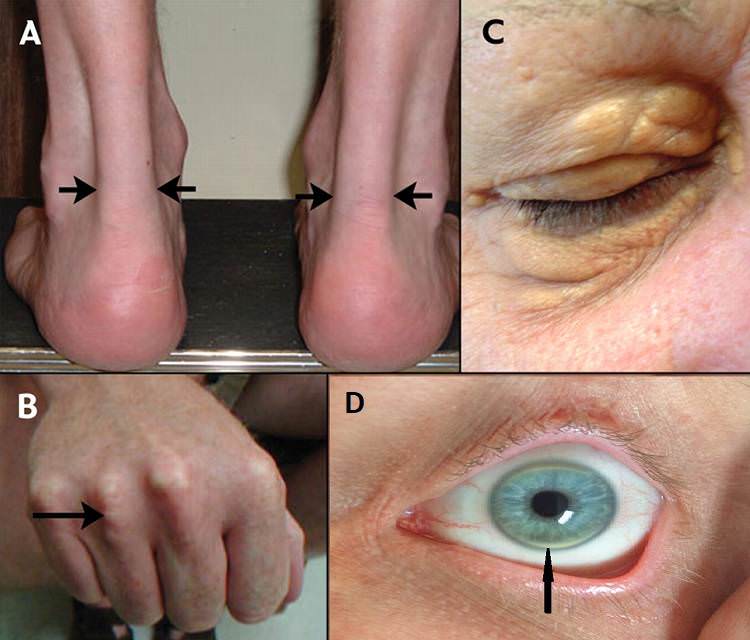 Проявления гиперхолестеринемии