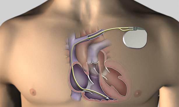 Имплантируемый кардиовертер-дефибриллятор