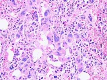 Как диагностировать и лечить миелофиброз?