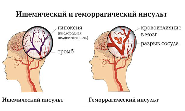 Отличие между ишемическим и геморрагическим инсультом