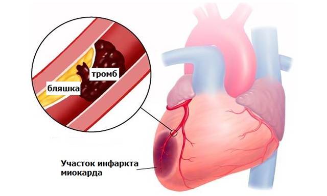 Появление тромба в коронарных сосудах
