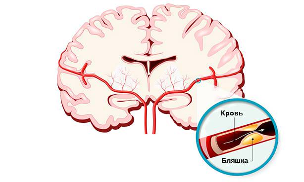 Атеросклеротическая бляшка в артериях мозга
