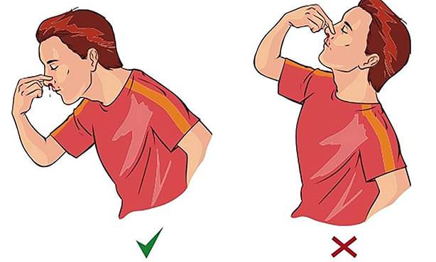 Способ остановить кровь из носа