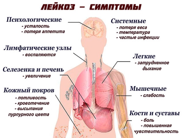 лейкоз у ребенка