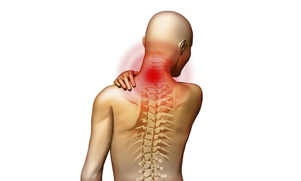 Остеохондроз шейного отдела