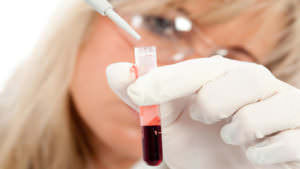 Расшифровка и сдвиги лейкоцитарной формулы