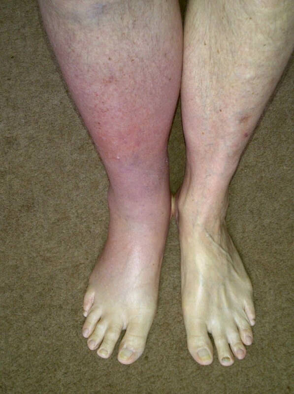 Флебит на ноге