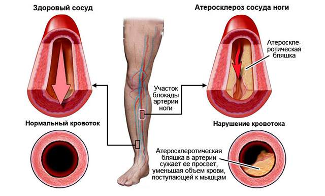 Атеросклероз артерий нижних конечностей