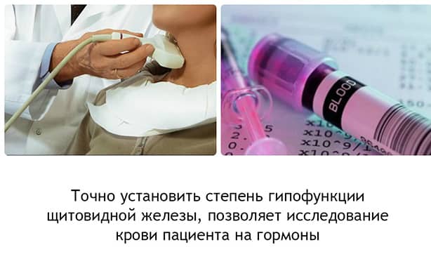 Диагностика гипотиреоза