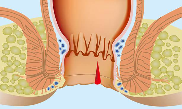 Трещина ануса