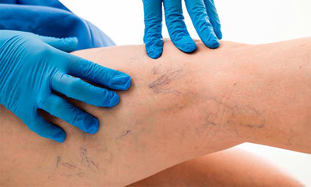 Варикозно расширенные вены на ногах