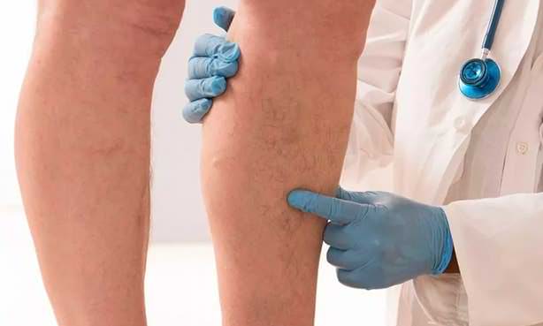 Проявления варикоза на ногах