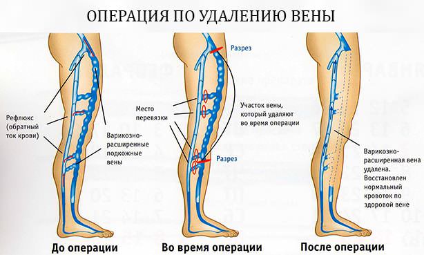Изображение вены до и после операции