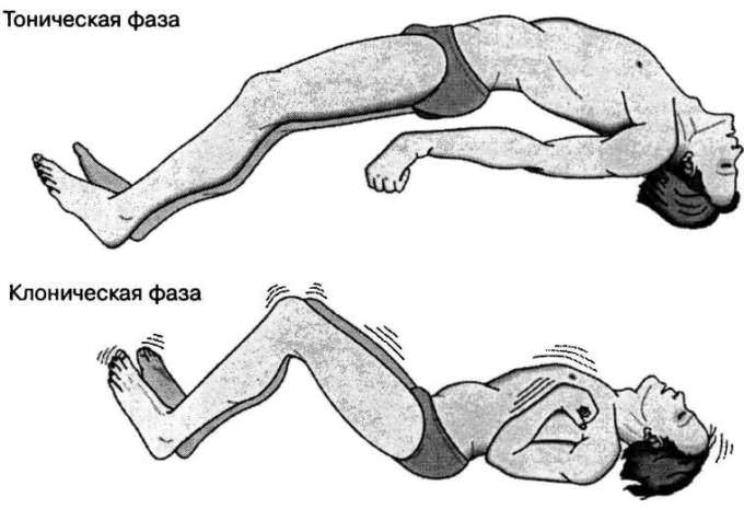 Судороги тонические и клонические