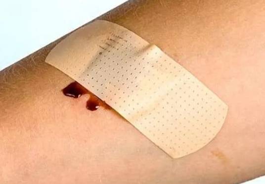 Сепсис крови что это такое, последствия и лечение