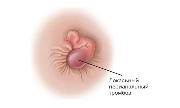 Локальный перианальный тромбоз