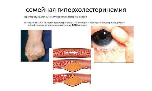 Семейная гиперхолестеринемия