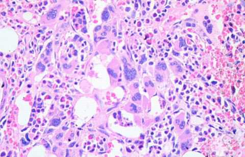 mielofibroz_vtorichniy Как диагностировать и лечить миелофиброз?